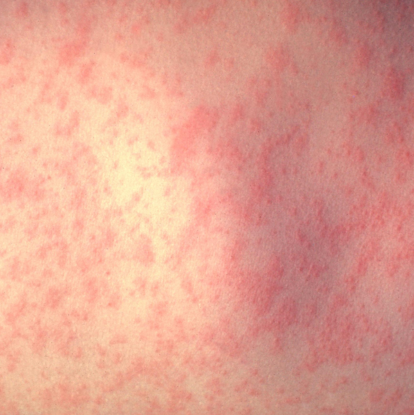File:Measles.png