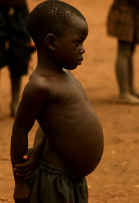 Kwashiorkor.png