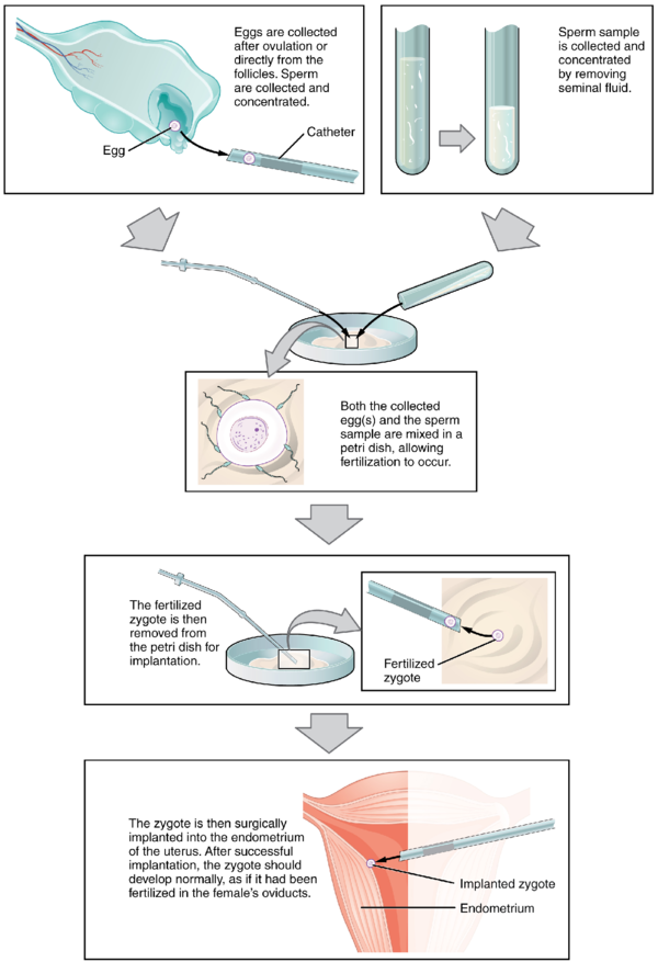 IVF.png