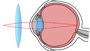 EyeLongSightedCorrection.png